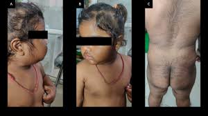 Image result for Precocious Puberty