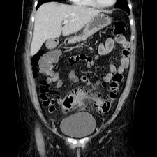 Image result for Diverticulitis