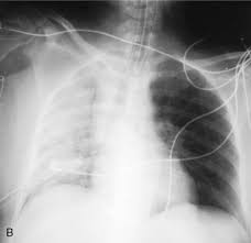 A loculated pleural effusion can mimic a mass hence is sometimes known as a pleural pseudotumor. Pleural Effusions And Complications Thoracic Key