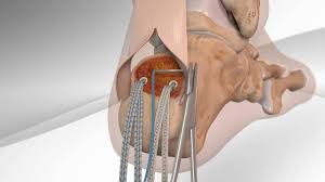 Achilles Tendon Repair With Arthrex Speedbridge