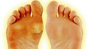 How To Treat Calluses Get Rid Of Calluses Dead Skin On Feet Foot Callus Feet Care Calluses