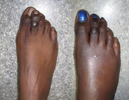 As the saying goes, eyes are the window to the soul, so it is important to keep them as sharp and clear as possible. Cosmetic Foot Surgery Total Health