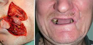 It takes the form of a large leathery slender flap and is found in the caribbean area at. The Neurotised Estlander Flap For Lip Reconstruction Jpras Open
