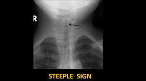 Image result for Croup Score