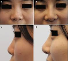 Update and Advancements in Facial Plastics