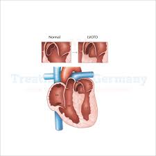 Image result for Left Ventricular Outflow Obstruction