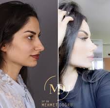 Estetik Burunestetigi Aesthetic Rinoplasti Plasticsurgery Rhinoplasty Estetikburun Plastikc Nose Plastic Surgery Perfect Nose Celebrity Plastic Surgery