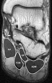 The muscles acting on the foot can be divided into two distinct groups; Fatty Muscle Atrophy Prevalence In The Hindfoot Muscles On Mr Images Of Asymptomatic Volunteers And Patients With Foot Pain Radiology