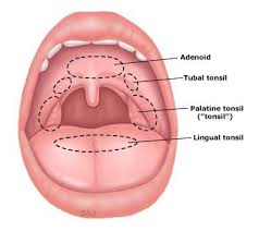 Hypertrophy of lingual tonsils can be safely and effectively managed by transoral robotic surgery via a minimally invasive approach. Med434 On Twitter Waldeyer S Ring Consists Of 1 Adenoids 2 Lingual Tonsils 3 Palatine Tonsils 4 Tubal Tonsils