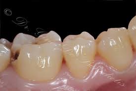 Image result for Diclis