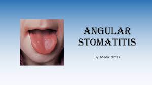 Image result for Angular Stomatitis