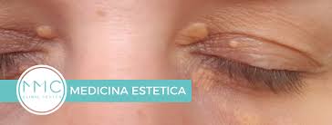 Image result for xantelasma