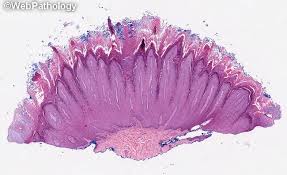 Image result for verrucae filiformes