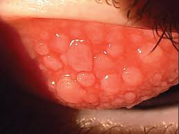 Image result for Vernal Conjunctivitis