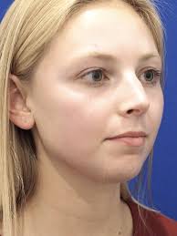 Endonasal Bridge Only 3312