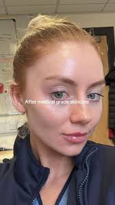 Zo Skincare Routine Before After