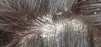 5 Home Remedies To Get Rid Of Dandruff Are You Still Suffering From The Itchy Scalp Here Are 5 Home Remedies Getting Rid Of Dandruff Dandruff Flakes Dandruff