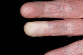 When your limbs can't get enough blood, your hands or feet may feel cold or numb. Raynaud S Nhs