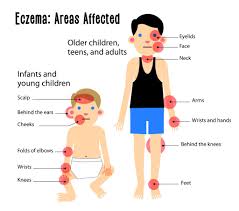Image result for Atopic eczema atopic dermatitis