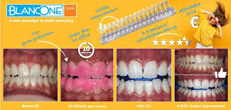 Check spelling or type a new query. Blancone Malaysia No Gingival Barier No Pain No Sensitive 10 Minutes Affordable Price Blancone Click Only Available In Dental Clinic Https Www Blancone Eu En Authorised Centres 10min Blancone Lowcost Nopain Nosensitive Whitening