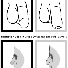 Illustrations of circumcised and uncircumcised penis. | Download Scientific  Diagram