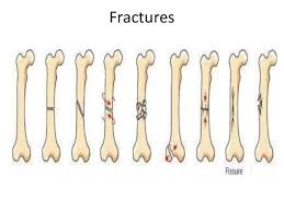 A labeling of the long bone. Exemplar 13 2 Fractures Quiz