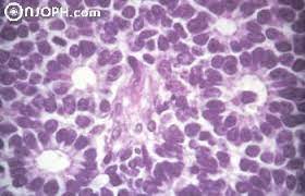 Fleurettes are considered the most differentiated form of rosette found in the tumor. Atlas Of Ophthalmology