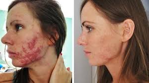 If you do decide to go on isotretinoin, i have two words of advice: All You Need To Know About The Accutane Isotretinoin Acne Treatment In Singapore
