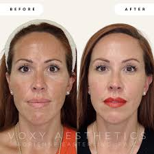 This beauty was a model from my most recent Natural Trough Masterclass! 💉  ⠀⠀⠀⠀⠀⠀⠀⠀⠀ Areas treated: temples, undereyes and midface. ⠀⠀⠀⠀⠀⠀⠀⠀⠀ We  refreshed her under eyes to rewind the clock using my