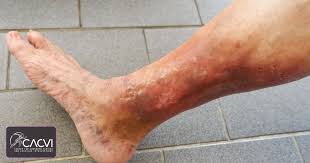 Image result for Pigment stains on the shin