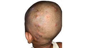 Image result for folliculitis symptoms