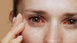 Image result for Eye Pain