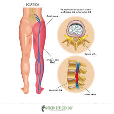4 Simple Acupressure Points To Treat Sciatica Nerve Pain At Home