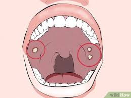 Some dentists may use additional tests (different types of lights to detect abnormal cells) to aid in identifying areas of abnormal cells in your how to know if i have i have oral cancer? How To Recognize Signs Of Oral Cancer 11 Steps With Pictures