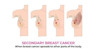 In this type of breast cancer, the cancerous cells block the blood vessels that are responsible for supplying blood to the skin, thus resulting in the as the breast cancer starts to spread throughout the body and begins to affect other organs, the following late signs and symptoms might be observed. Secondary Breast Cancer Poorti A Product Of Aarna Biomedical