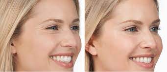 Visible results can last up to four months. How Long Do Botox Or Dysport Treatments Take The Medspa Blog