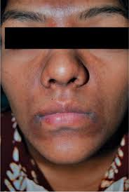Image result for Diffuse Hyperpigmentation