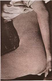 The skin is one of the largest organs in the body and communicates directly with both the external and internal. Ichthyosis Wikipedia