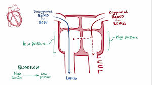 Ventricular Septal Defect Vsd Pediatrics Msd Manual