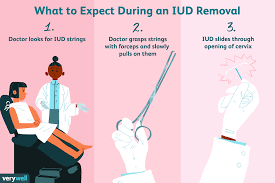 What To Expect During Your Iud Removal
