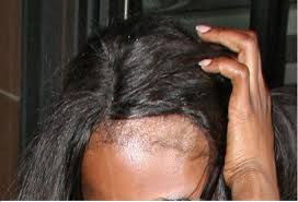 Now that you have unwanted black hair it is time to see how to get to a color that compromises between your natural color and one that looks good on you. Thinning Edges Natural Hair Woman Natural Hair Natural Hair Care Natural Hairstyles Regrow Edges Treatments