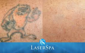 Tattoo advanced specialized treatment options | picosure laser tattoo removal. Laser Tattoo Removal Remove Unwanted Tattoos Laserspa Of Tampa Bay