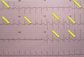 Pericarditis is inflammation of the pericardium (the fibrous sac surrounding the heart). Pathologies Pericardiques Et Myocardiques Engageant Le Pronostic Vital Medscape