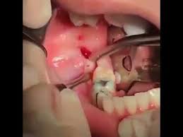 Necessity Of Wisdom Teeth Extraction In 2021 Wisdom Tooth Extraction Wisdom Teeth Tooth Extraction