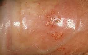 Image result for genital herpes