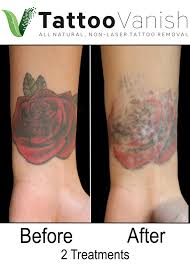 Contrary to the old belief that light, colored ink was hard to remove. Tatto Wallpapers Tattoo Removal After 2 Sessions
