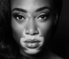 Image result for Vitiligo