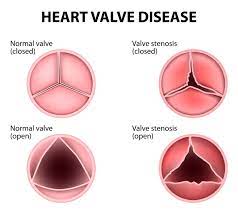 Heart Murmur Harvard Health