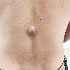 Lipom Liposarkom Ursache Symptome Diagnose Entfernung