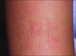 Any of the models' body features, accessories, clothing, tattoos etc. Post Inflammatory Hyperpigmentation Following Sensitisation At The Site Download Scientific Diagram